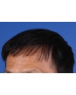 After Hair Transplant&nbsp;2 Sessions (Areas)